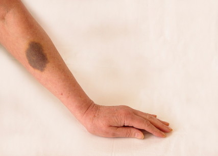 An image of a bruised arm.