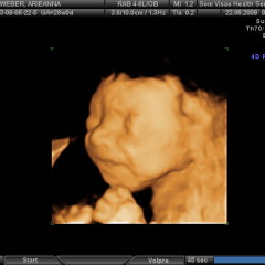 A 3D ultrasound image depicts an infant's face. - Image courtesy of Ianiv & Arieanna (http://bit.ly/1fdVxDw)