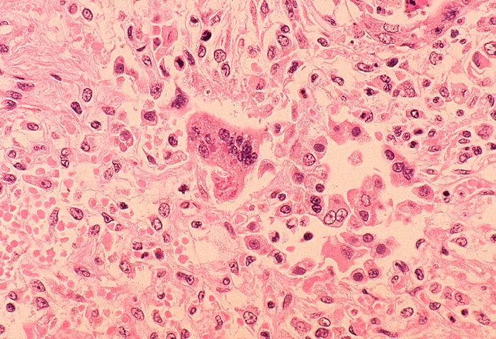 Histopathology of measles pneumonia. Photo courtesy of the Center for Disease Control and Prevention
