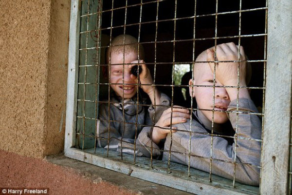 Two albino children in Tanzania