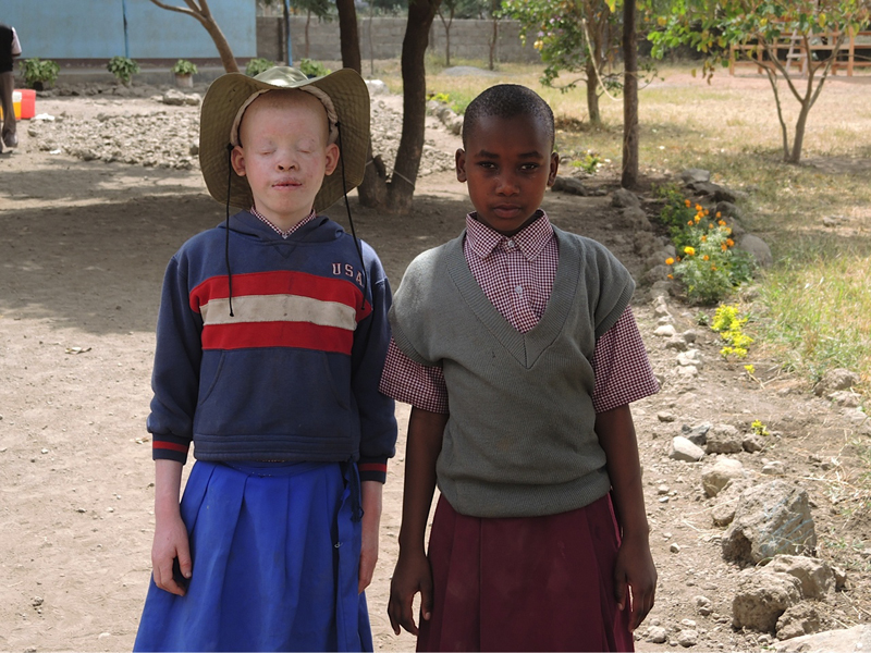 People with albinism suffer from varying degrees of low vision, and most are considered legally blind. Photo courtesy of Global Sisters Report / Melanie Lidman