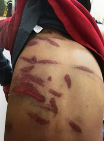 Some of the wounds suffered by the 7-year-old boy. Image is evidence filed in Marion (Ind.) Superior Court via The Indianapolis Star
