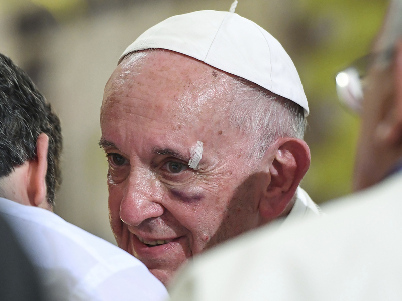 A bruised Pope Francis smiles during his visit to the Sanctuary of St. Peter Claver, in Cartagena, Colombia, Sunday, Sept. 10, 2017. Pope Francis wrapped up his Colombia trip with a deeply personal final day honoring St. Peter Claver, a fellow Jesuit who ministered to hundreds of thousands of African slaves who arrived in the port of Cartagena to be sold during Spanish colonial times. (Alessandro Di Meo/Pool via AP)
