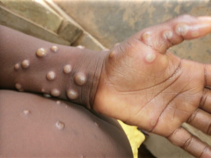 An undated photo of an individual infected with monkeypox. Photo courtesy of
Nigeria Centre for Disease Control/WHO